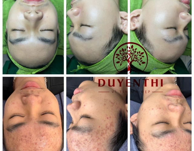 Dịch vụ nặn mụn chuyên sâu – Giải pháp cho làn da mịn màng tại Dung Nguyễn Spa