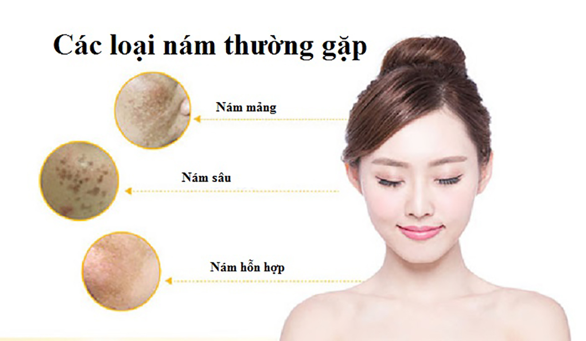 Trị Nám và Tàn Nhang Dĩ An Bình Dương