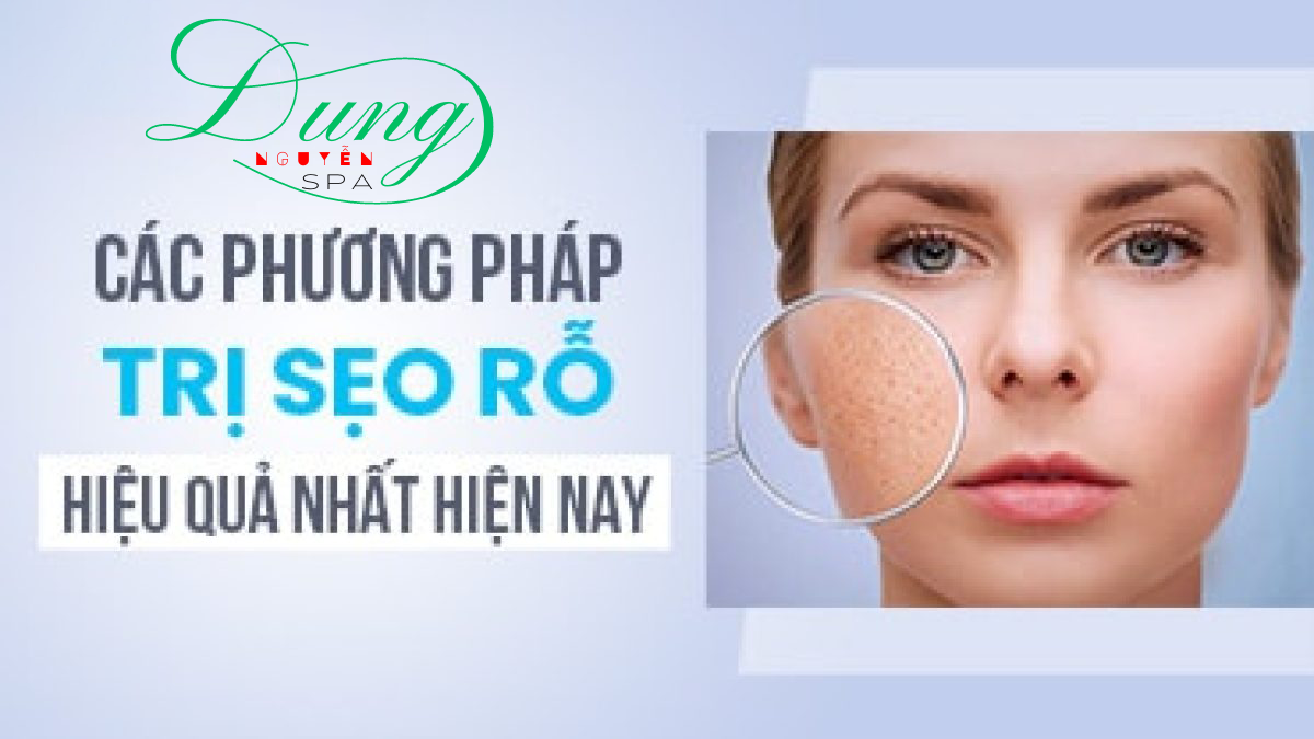 Các phương pháp trị sẹo rỗ dĩ an bình dương