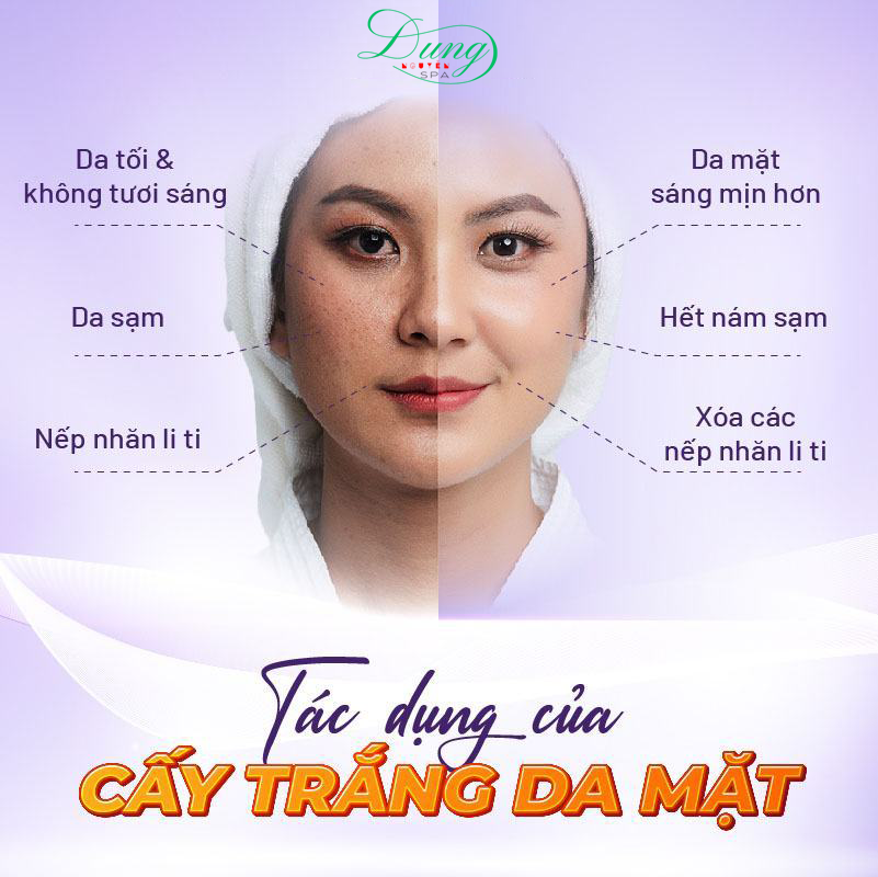 Tại Sao chọn Cấy Trắng Da Mặt